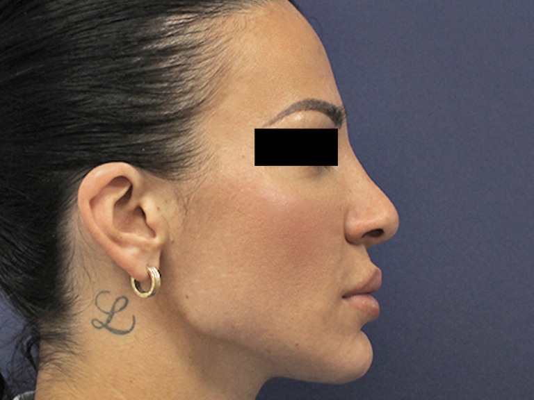 Nose correction - patient 16