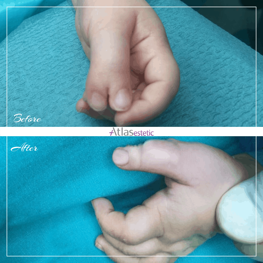 polydactyly surgery