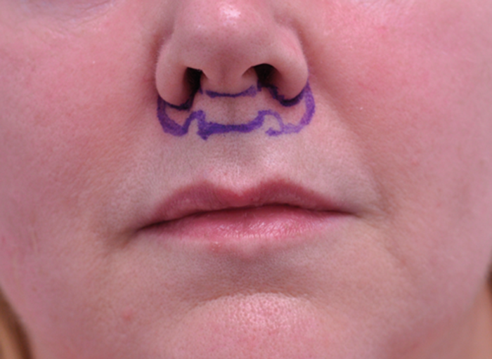 bullhorn lift isecanje kože ispod nosa
