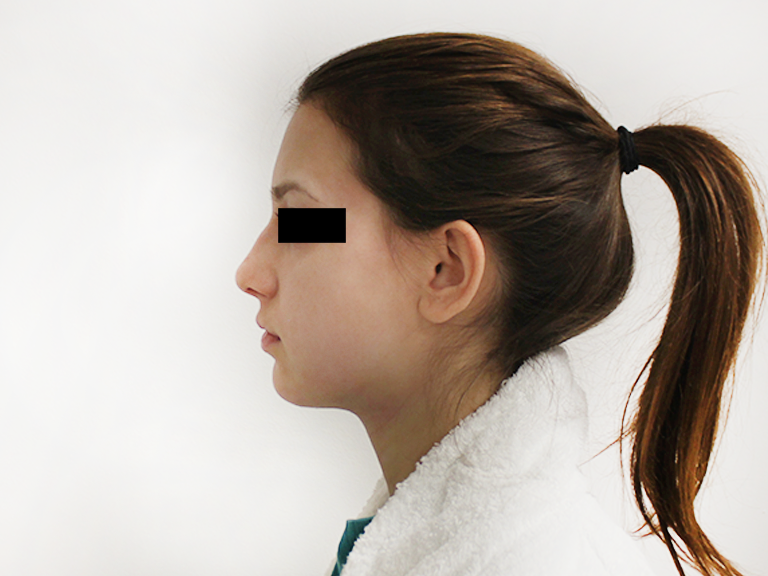 Nose correction - patient 17