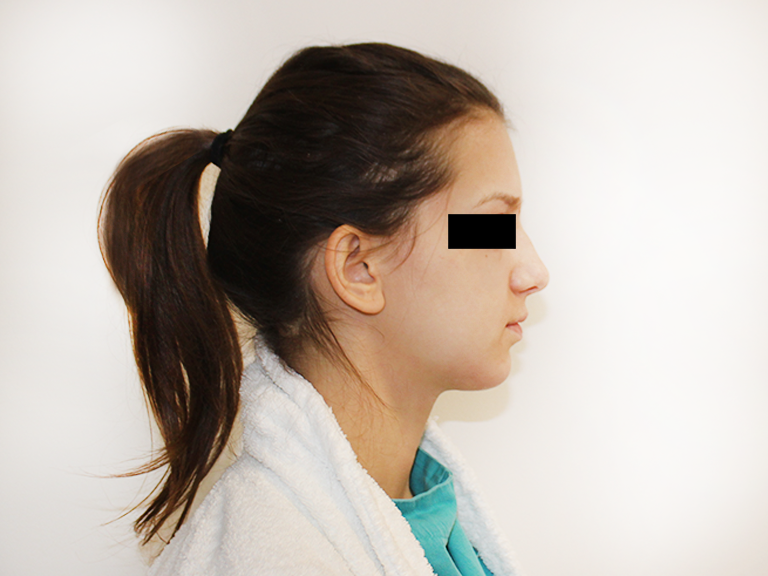 Nose correction - patient 17