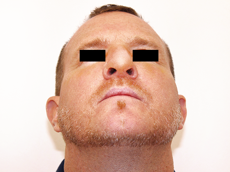 Korekcija nosa posle - pacijent 18