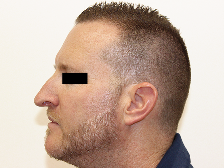 Korekcija nosa pre -- pacijent 18