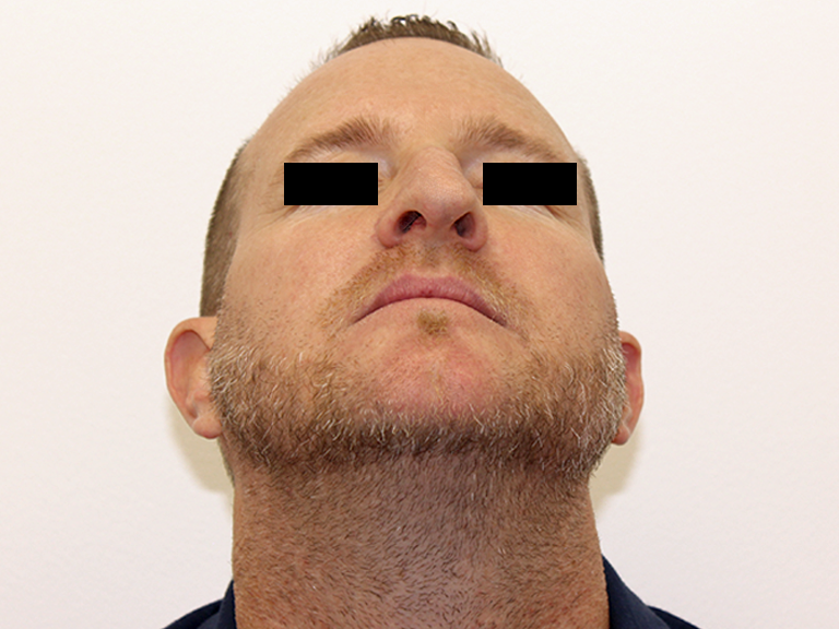 Korekcija nosa pre - pacijent 18