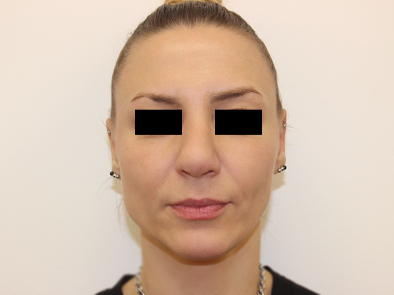 Pacijent 19 -- Posle operacije nosa