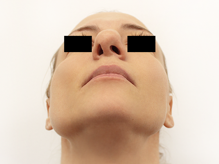 Pacijent 19 - Pre operacije nosa
