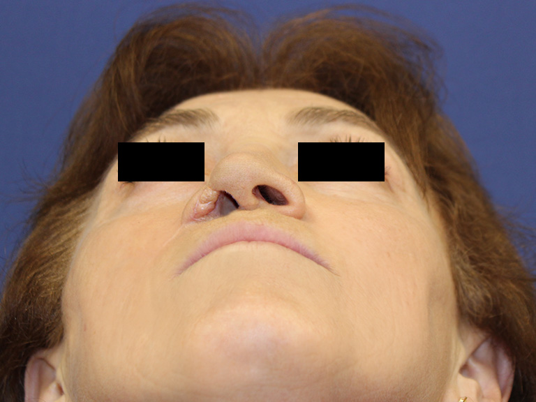 Pacijent 20 -- Pre operacije nosa