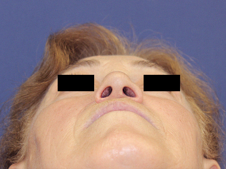 Pacijent 20 -- posle operacije nosa