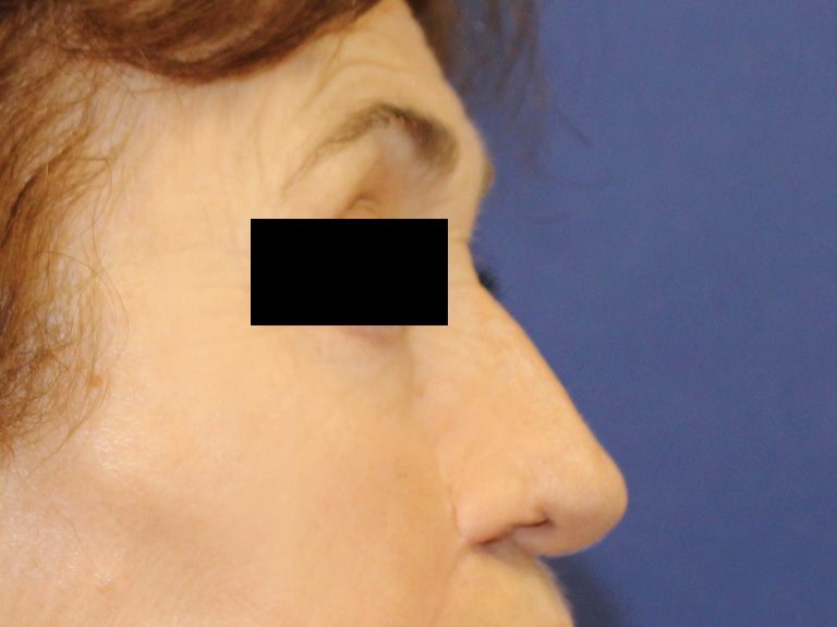 Patient 20 --- after nose correction