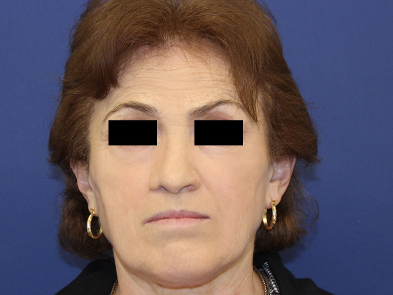 Pacijent 20 - posle operacije nosa