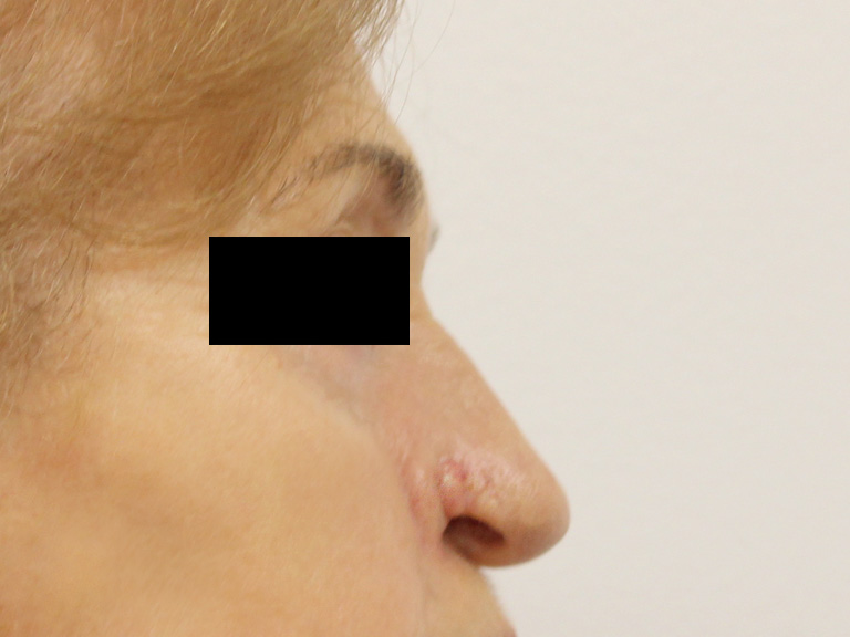 Patient 20 --- before nose correction