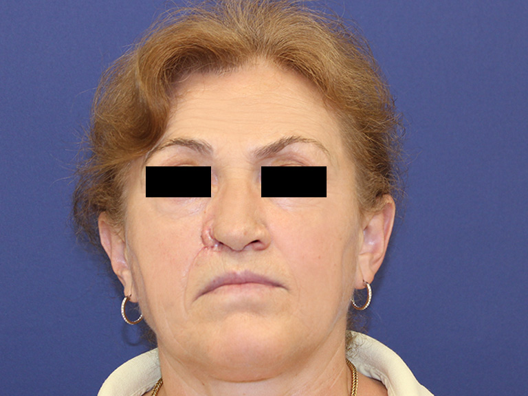 Pacijent 20 - pre operacije nosa
