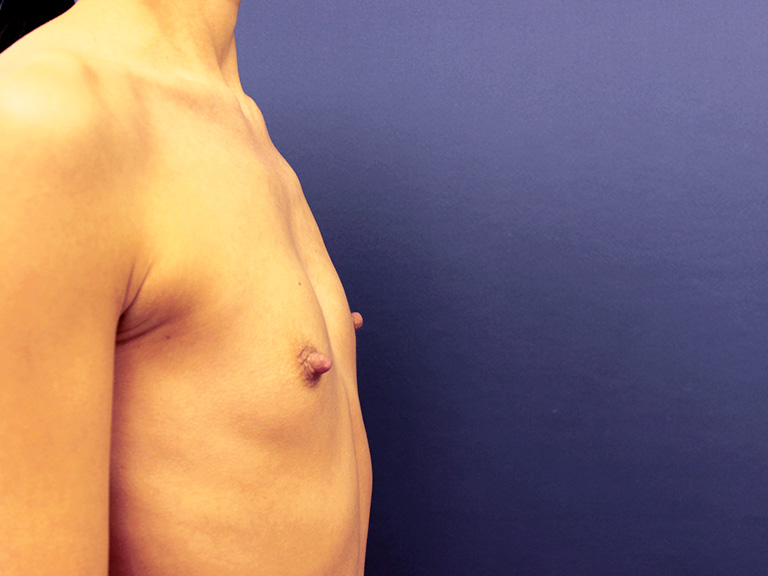 Patient 22 -- before breast augmentation