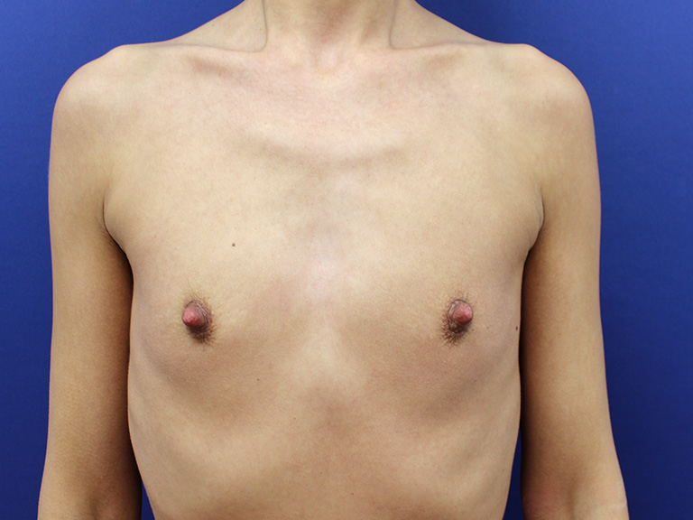 Patient 22 - before breast augmentation