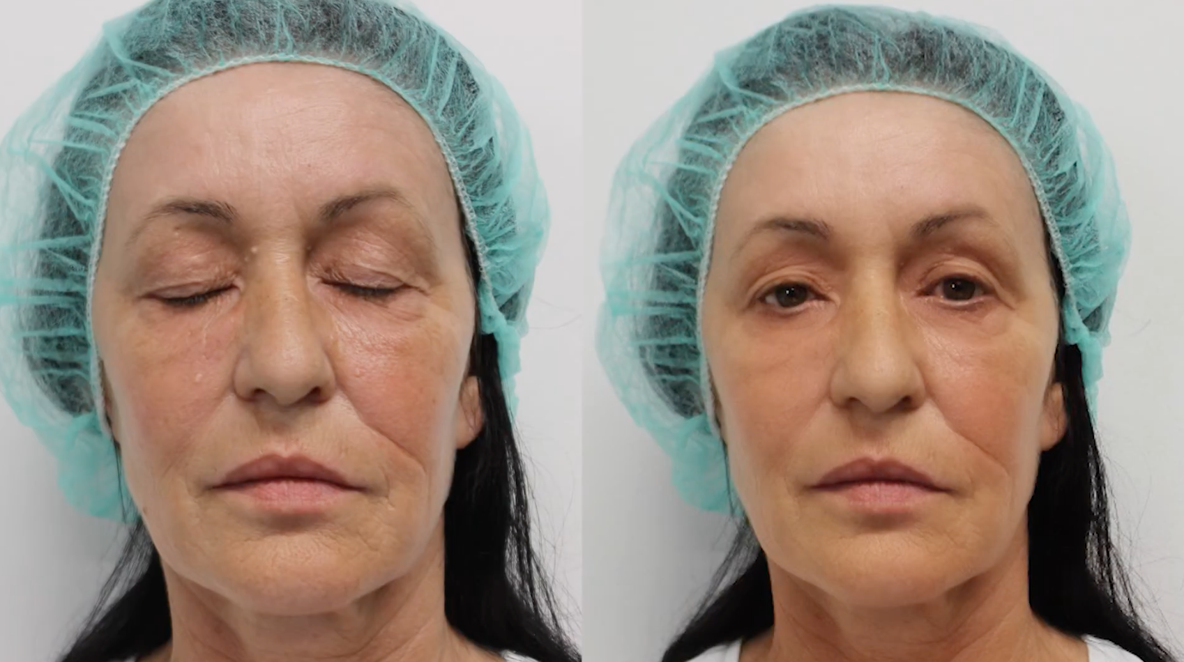 Patient before and after facial laser peeling