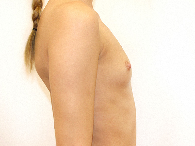 Patient 26 -- Before breast augmentation