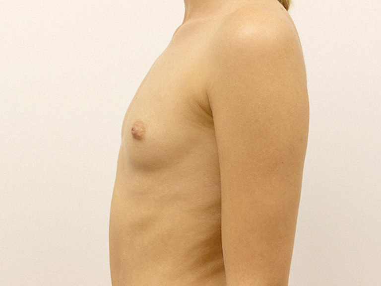 Patient 26 --- Before breast augmentation